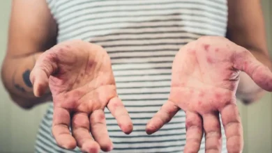 confirman tres casos de sarampión en comondú y activan cerco sanitario